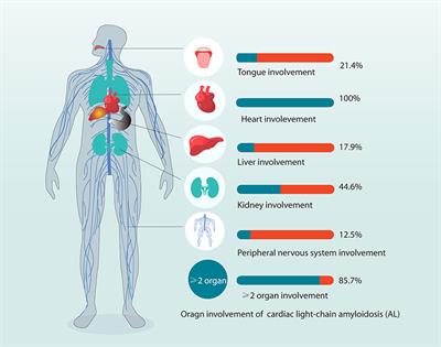 Prognostic Value of Circulating sST2 for the Prediction of Mortality in Patients With Cardiac Light-Chain Amyloidosis